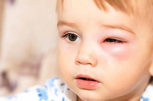 Mách mẹ cách chữa lẹo mắt ở trẻ em nhanh chóng, hiệu quả