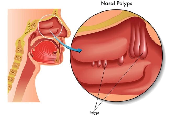 Nước mũi là cách cơ thể chống lại sự xâm nhập của vi khuẩn, virus