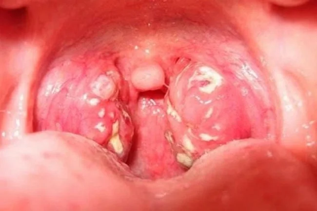 Trẻ bị viêm amidan