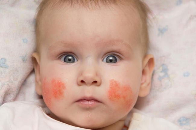 Bé bị chàm sữa
