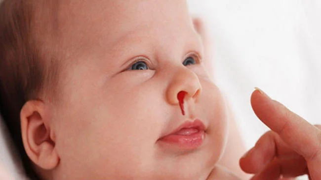 Bé bị chảy máu cam khi ngủ nguy hiểm không?