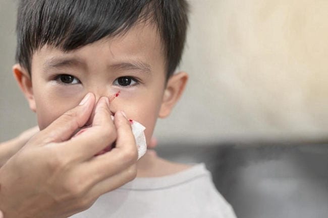Bóp chặt 2 bên cánh mũi trong khoảng 10 phút khi trẻ bị chảy máu cam