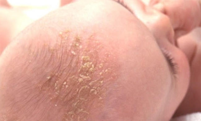 cách trị nấm da đầu cho bé