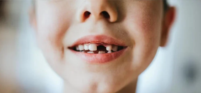 cách trị sâu răng cho trẻ tại nhà