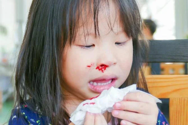 Chảy máu cam thường xuất hiện ở nhóm trẻ từ 2 – 10 tuổi