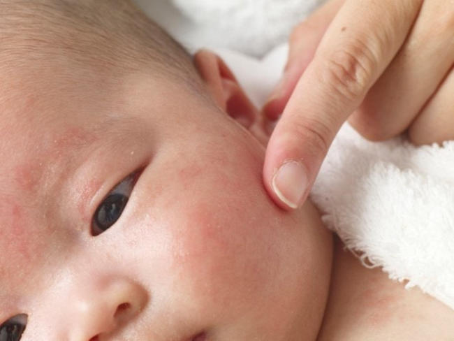 Da bé nổi hạt sần sùi là hiện tượng không quá nguy hiểm