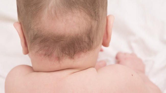 Nhận biết nấm da đầu ở trẻ em - Cần làm gì để xử lý?