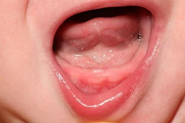 Dấu hiệu sưng lợi, nướu đỏ có thể là dấu hiệu cho thấy răng bé sắp mọc