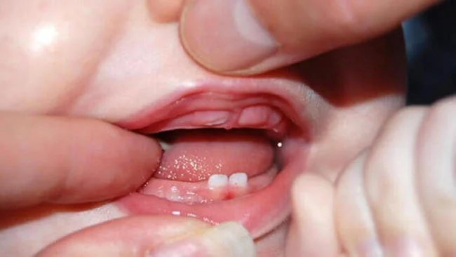 Dấu hiệu trẻ sắp mọc răng hàm