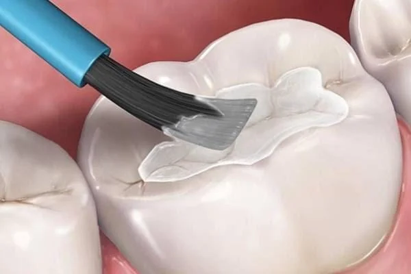 Điều trị sâu răng cho bé triệt để