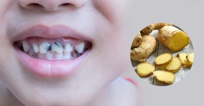 Dùng gừng trị sâu răng cho bé