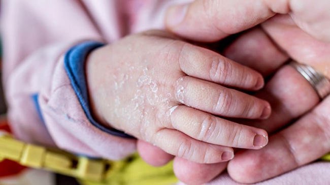 Hiện tượng lột da trong giai đoạn sơ sinh