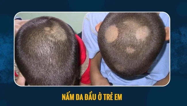 Hiện tượng nấm da đầu ở trẻ nhỏ