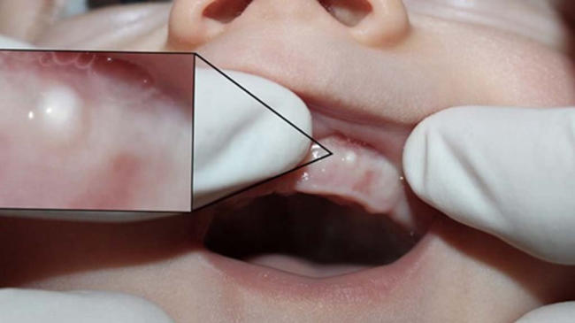 hinh anh nanh sua o tre so sinh 2