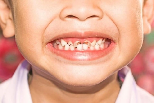 Không được chăm sóc thường xuyên răng có thể bị sâu