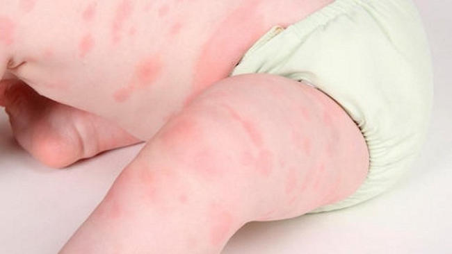 Trẻ sơ sinh bị nổi mẩn đỏ khắp người - Fitobimbi