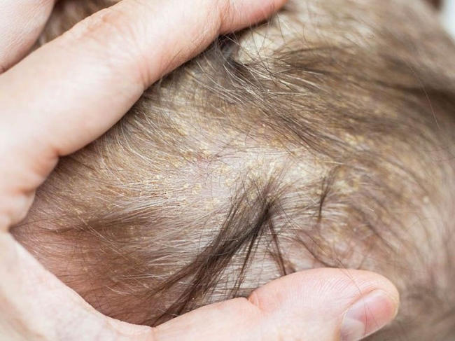 Những hình ảnh nấm da đầu ở trẻ sơ sinh bạn nên biết