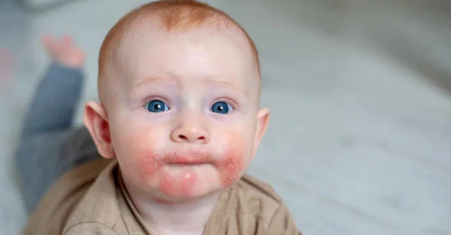 Nhiễm nấm ngứa ở trẻ sơ sinh