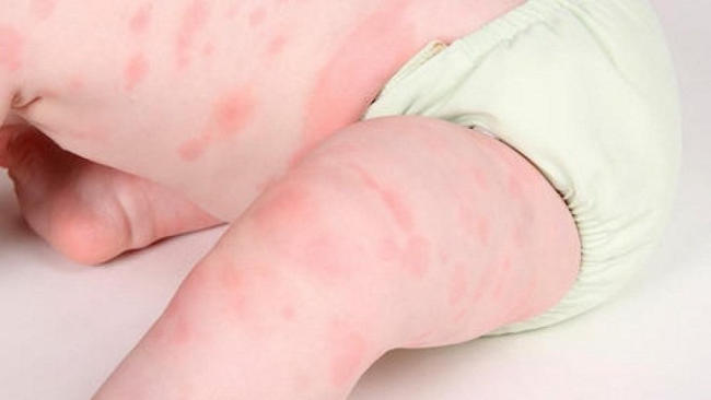 Nổi mề đay khiến da bé bị nổi hạt sần sùi không ngứa