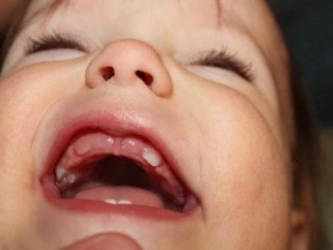 Răng của bé đã dần nhú lên