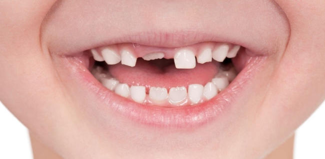 Răng sữa của bé nhỏ và trắng hơn răng vĩnh viễn