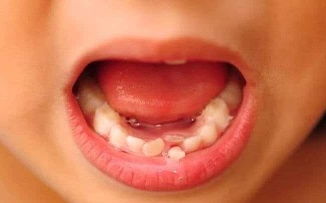 Răng sữa mọc lệch không liên quan đến răng vĩnh viễn