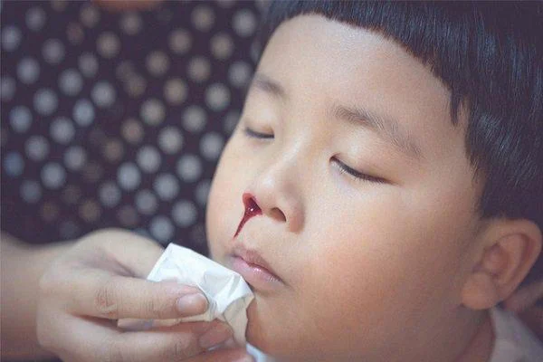 Thiếu vitamin C khiến trẻ dễ bị chảy máu cam hơn những trẻ khác