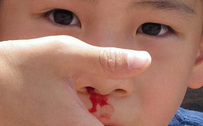 Trẻ bị chảy máu cam khi ngủ không quá nguy hiểm nếu được sơ cứu kịp thời và đúng cách