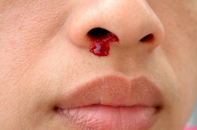 Trẻ bị chảy máu cam thường xuyên có thể là dấu hiệu của bệnh bạch cầu