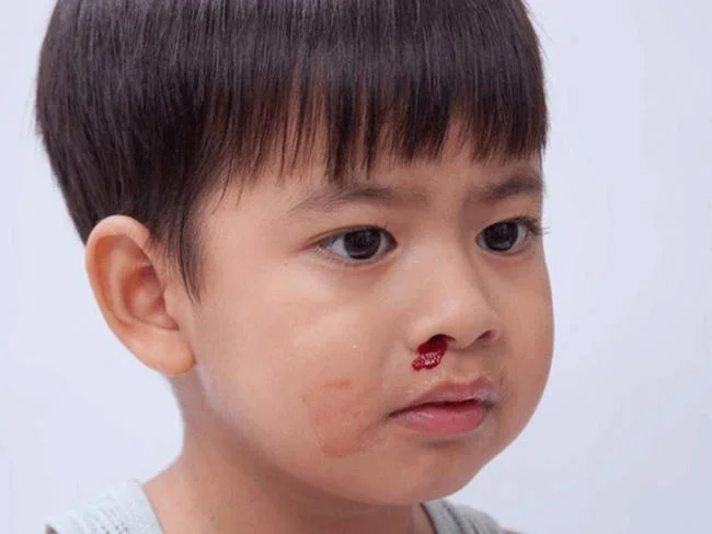 Trẻ bị chảy máu cam và không rõ nguyên nhân