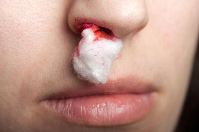 Trẻ bị rối loạn tiểu cầu và thường xuyên chảy máu cam