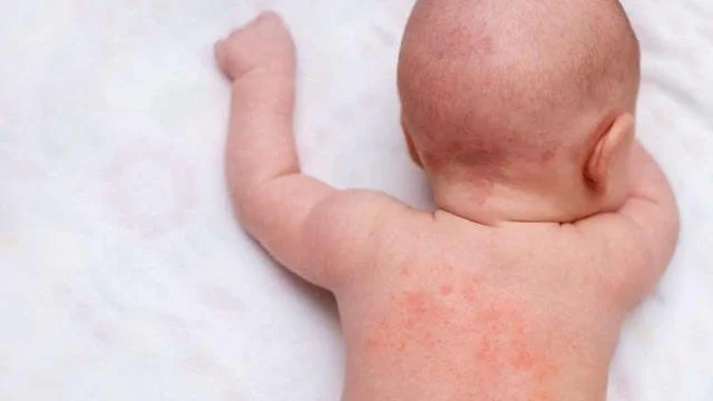 Trẻ bị rôm sảy