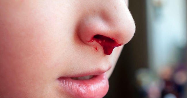 Trẻ hay bị chảy máu cam có thể do lệch vách ngăn mũi