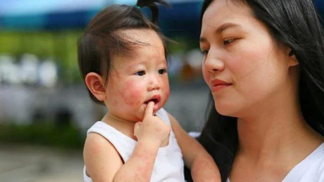 Trẻ sơ sinh bị dị ứng thời tiết
