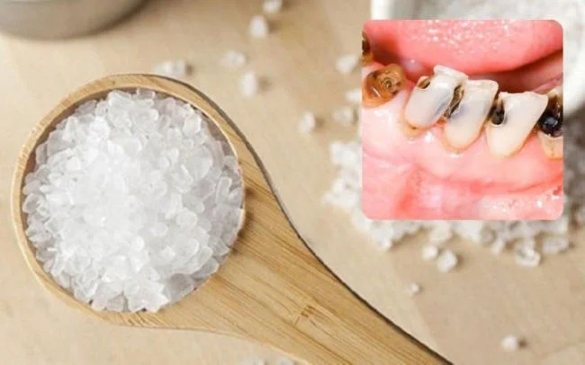 Trị sâu răng bằng nước muối