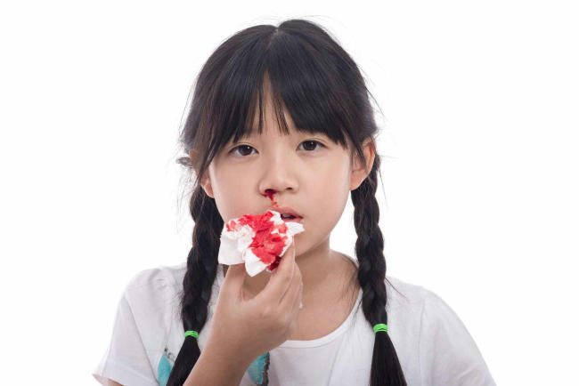 Triệu chứng chảy máu cam ở trẻ em