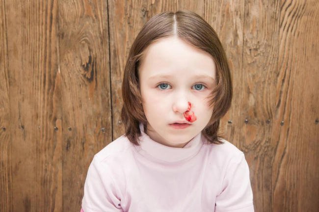 Trẻ bị chảy máu mũi nên làm gì để ngừng máu?
