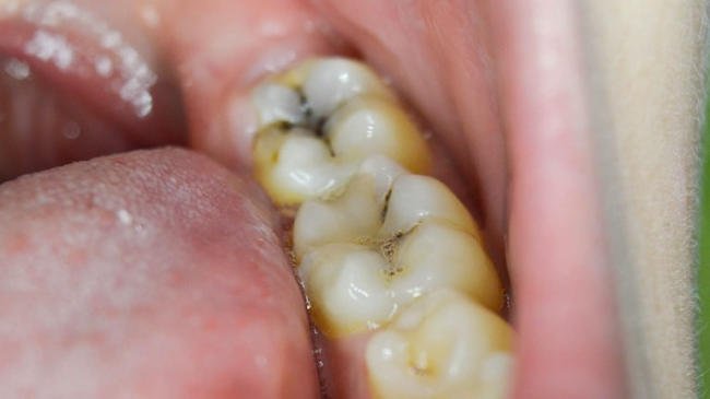 Bề mặt răng bị sâu