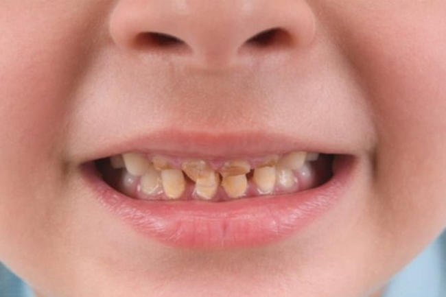 Sún răng ở trẻ  Nguyên nhân và 4 cách điều trị hiệu quả  Nha Khoa Quốc Tế