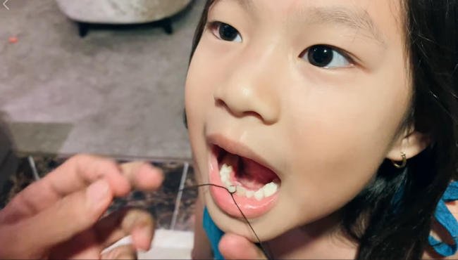 cách nhổ răng bằng chỉ