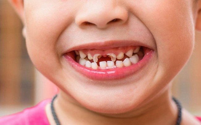 Cách xử lý khi răng sữa của trẻ bị mòn