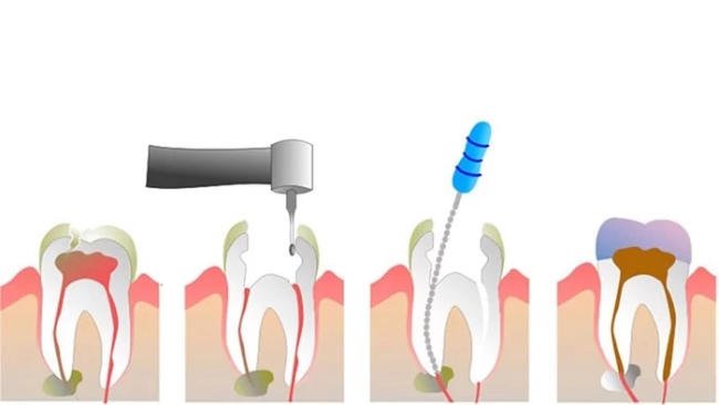 Lấy tủy và trám răng
