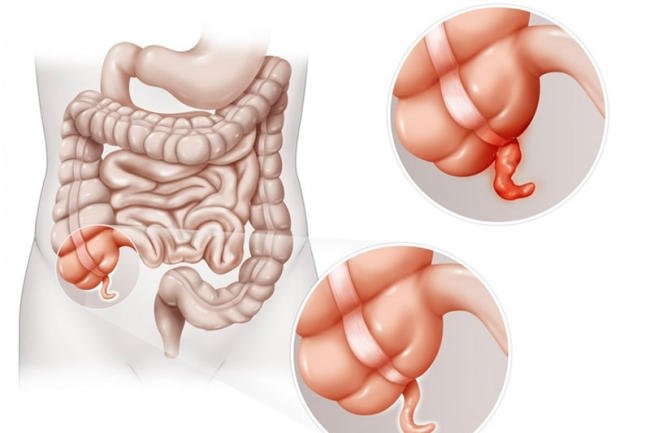 Nguyên nhân gây viêm ruột thừa ở trẻ em
