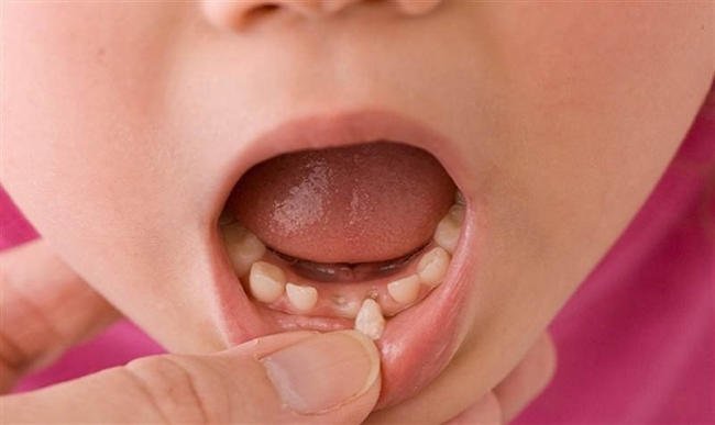 Làm thế nào để nhổ răng sữa lung lay cho trẻ một cách an toàn?