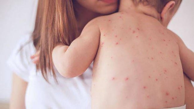 Rôm sảy có thể tự lặn, nhưng cũng rất dễ tái phát