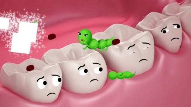 Sâu răng gây bởi một loại vi khuẩn có tên là Streptococcus mutans