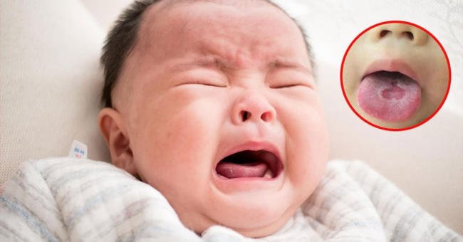 Trẻ bị tưa lưỡi nên vệ sinh lưỡi 4 ngày/lần