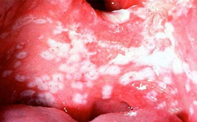 Các đốm trắng lan ra toàn miệng: má, vòm miệng, amidan, nướu, sau họng