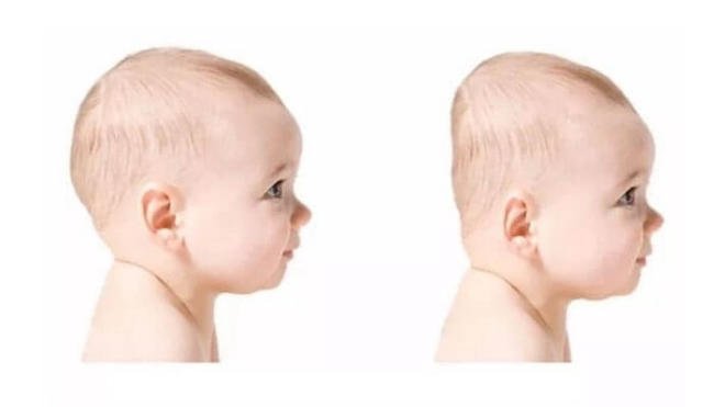 Có những cách chữa méo đầu cho trẻ 3 tháng tuổi nào?