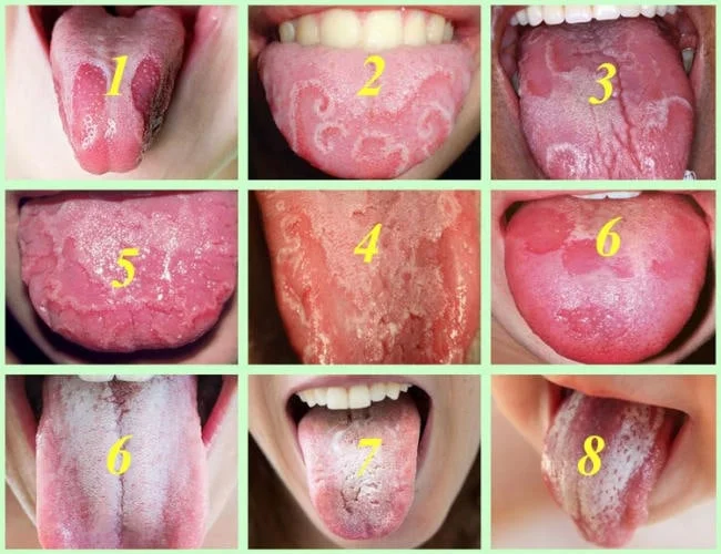 Hình ảnh nấm lưỡi ở trẻ và nguyên nhân, dấu hiệu